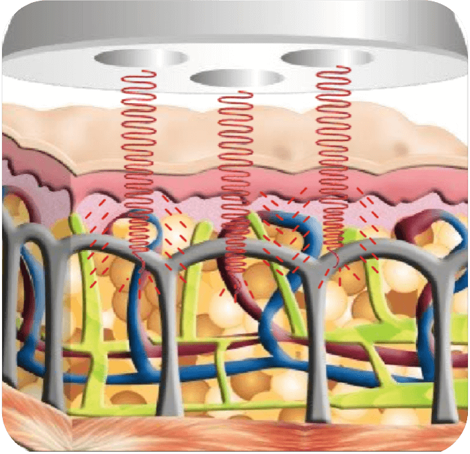 aplicacao-tecarterapia-estetica-neartek aplicacao-tecarterapia-estetica-neartek