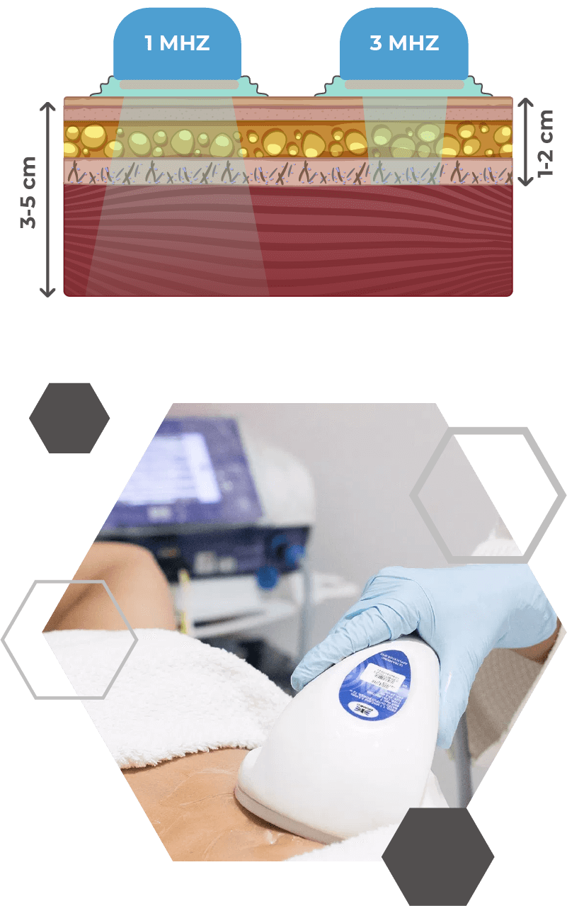 aplicacao-tecarterapia-estetica-intima aplicacao-tecarterapia-estetica-intima