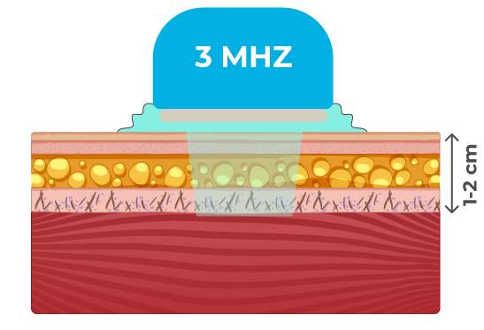 Ultrassom Ultrassom