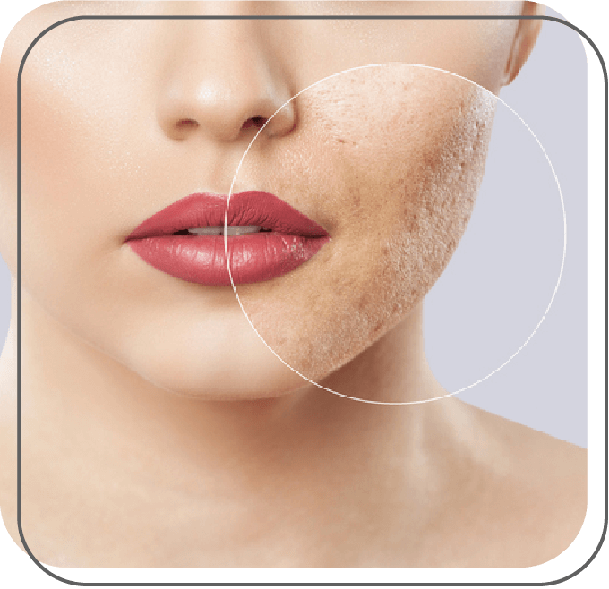Acne e Cicatrizes Acne e Cicatrizes