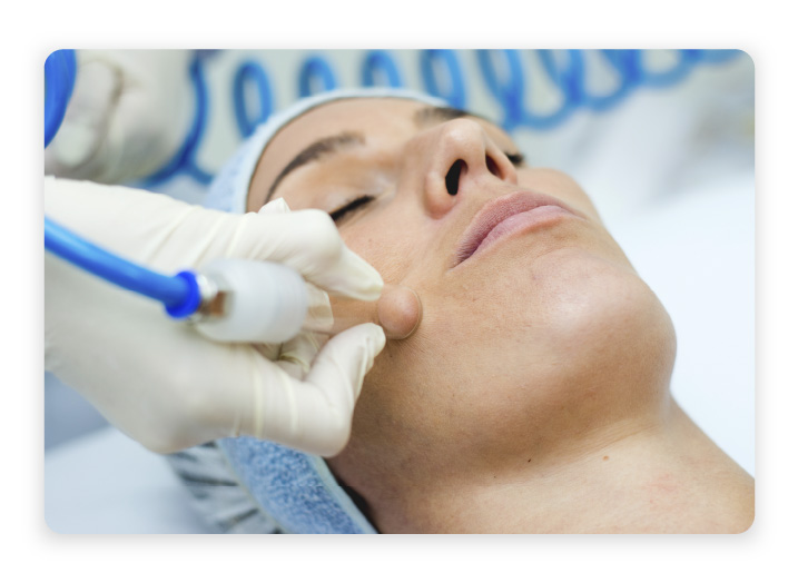 Vacuoterapia Vacuoterapia