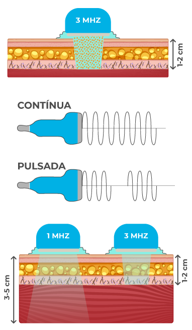 Sonopulse III Ibramed - Aparelho de Ultrassom Sonopulse III Ibramed - Aparelho de Ultrassom
